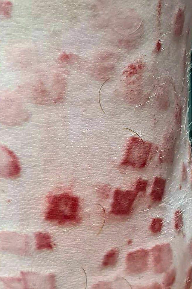 Viereckige Hautveränderungen aufgrund von Rotlauf am Schlachtkörper.